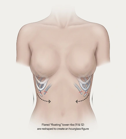 Illustration showing the flared lower ribs reshaped inward to create an hourglass figure